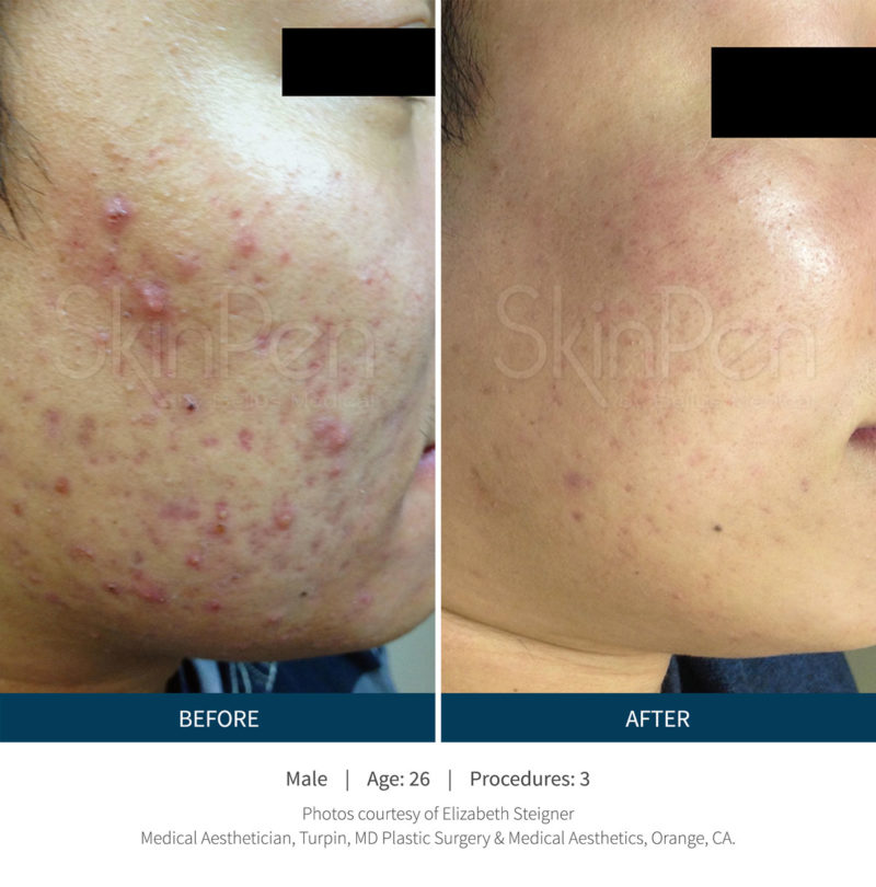 Microneedling Denver Acne Scars Before & After